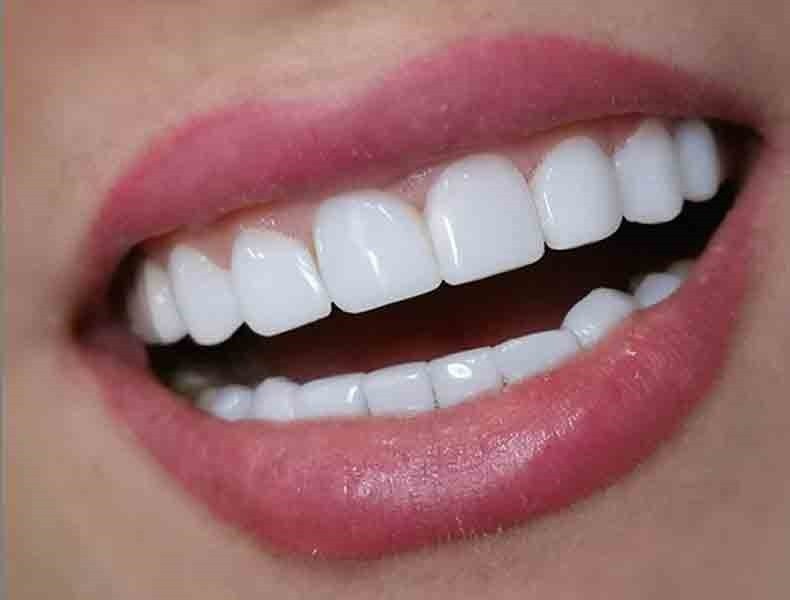 زیبایی لبخند با کامپوزیت دندان